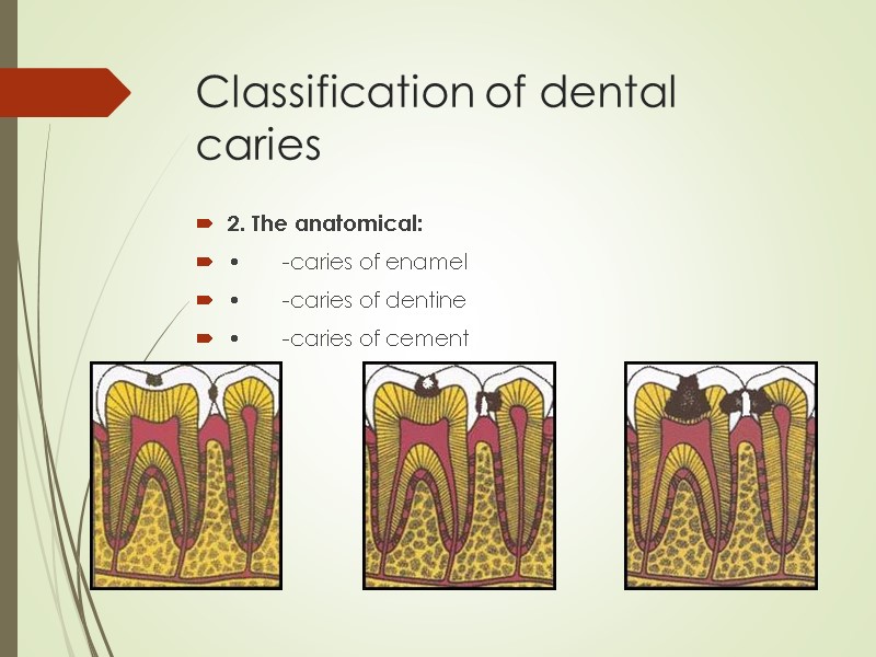 Classification of dental caries 2. The anatomical:  • -caries of enamel  •